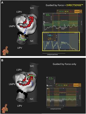 Improved Ablation Efficiency in PVI Guided by Contact Force and Local Impedance: Chronic Canine Model